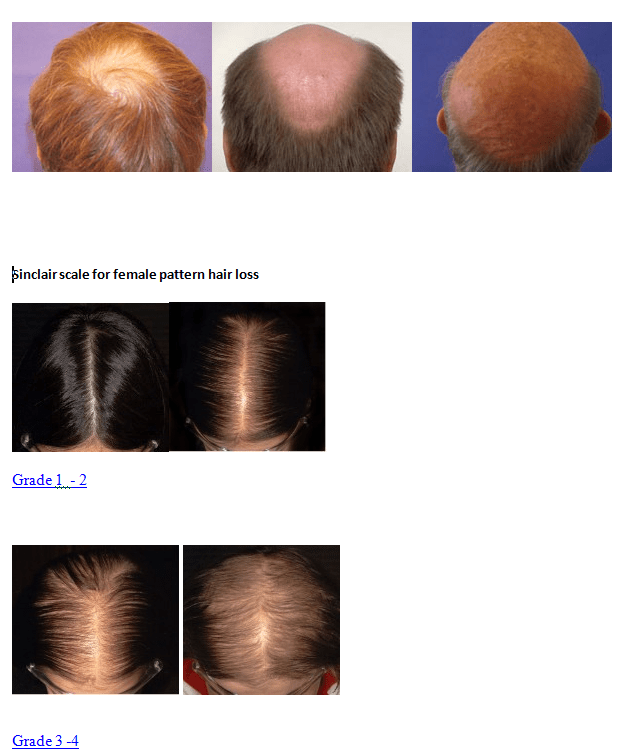 Regenera Activa Hair Loss Treatment Cost and Guide Physician Trainer
