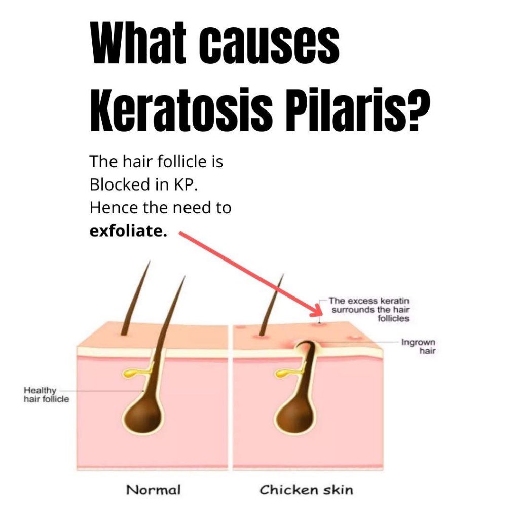 Best keratosis pilaris treatment in australia