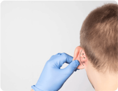 Otoplastia