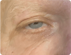 Ptose Palpebral