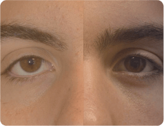 Retração Palpebral