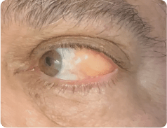 Hérnia subconjuntival