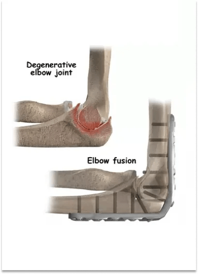 Elbow Fractures 12 Arthrodesis