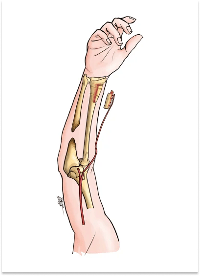 Elbow Fractures 9 Bone Grafting 1