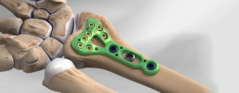 Wrist Fracture 3 Distal Radius Fractures