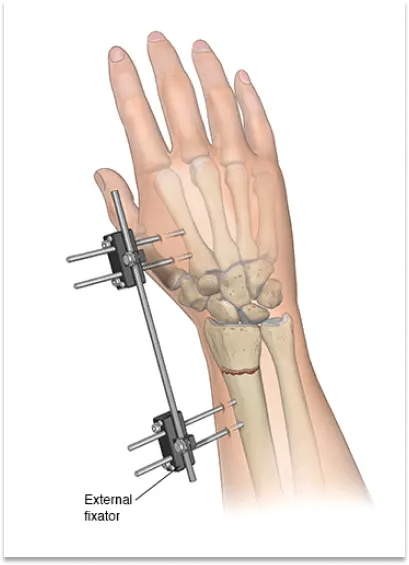 Wrist Fracture 10 External