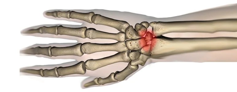 Wrist Fracture 5 Lunate Fractures