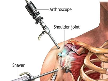 Shoulder Replacement 12 Minimally Invasive Shoulder Replacement