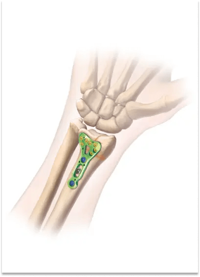 Wrist Fracture 9 Open Reduction And Internal Fixation Orif