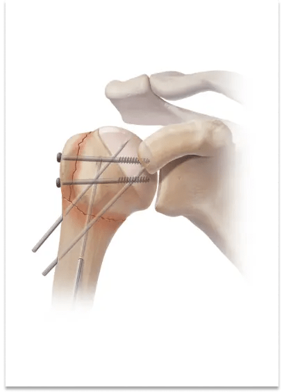 Wrist Fracture 8 Percutaneous Pinning