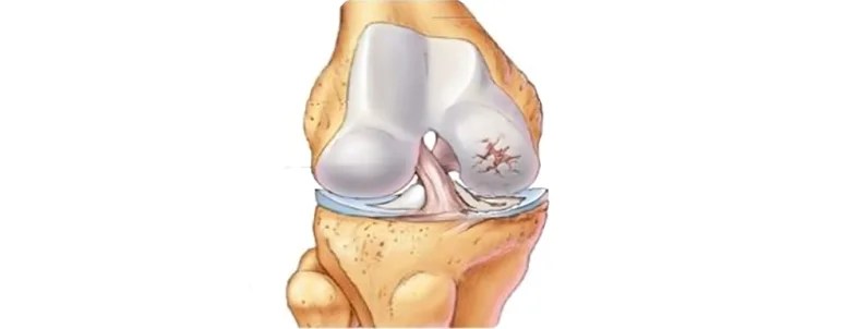 Elbow Replacement 5 Post Traumatic Arthritis 1