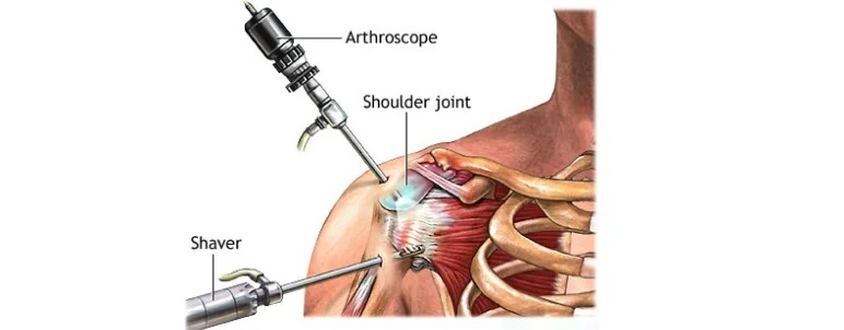Elbow Fractures 3 Recurrent Shoulder Instability