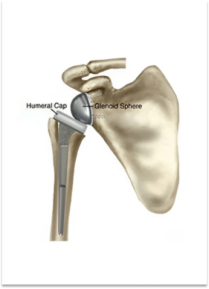 Shoulder Replacement 8 Reverse Total Shoulder Replacement