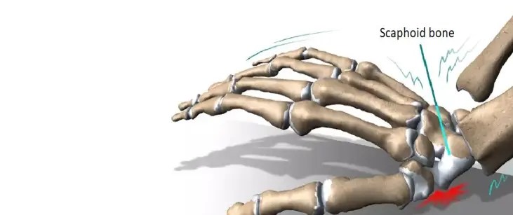 Wrist Fracture 4 Scaphoid Fractures