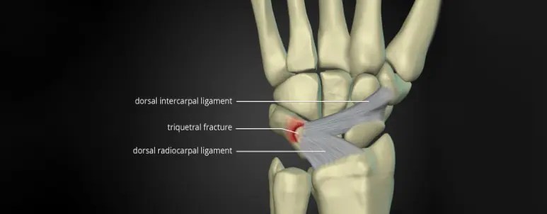 Wrist Fracture 6 Triquetral Fractures