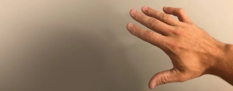Wrist Reconstruction 7 Wrist Deformities
