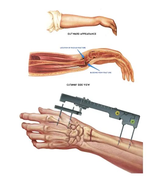 Wrist Fracture 2 Wrist Fracture