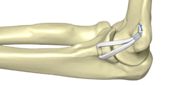 Elbow Reconstruction Surgery