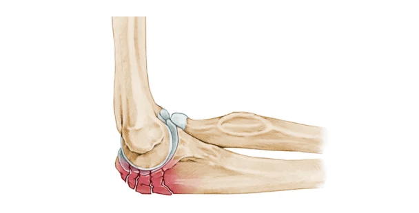 Elbow Surgery A Comprehensive Guide 6 Olecranon Fractures