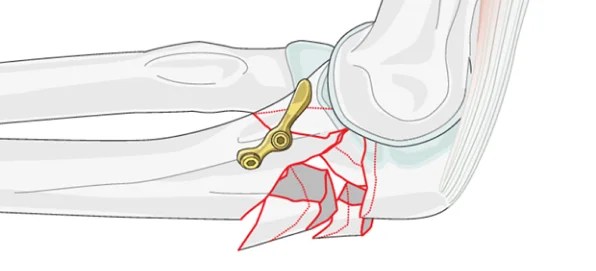 Open Reduction and Internal Fixation