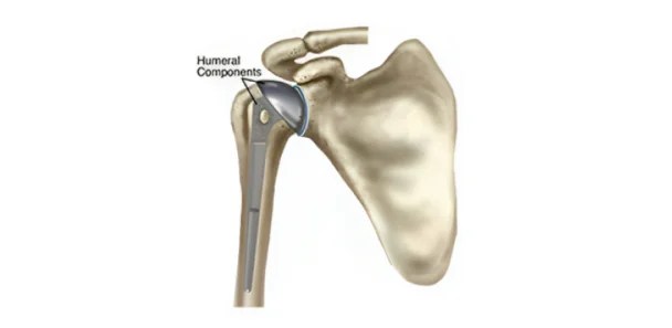 Shoulder Replacement Surgery:a Comprehensive Guide 8 Partial Shoulder Replacement
