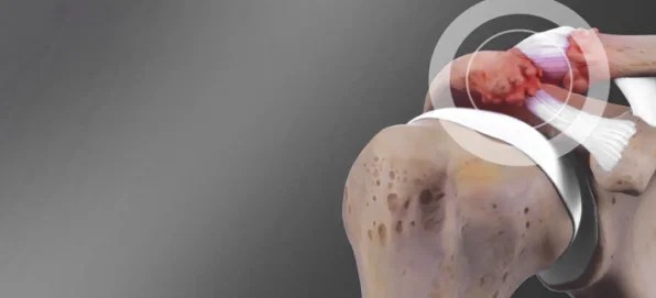 Post Traumatic Arthritis 2