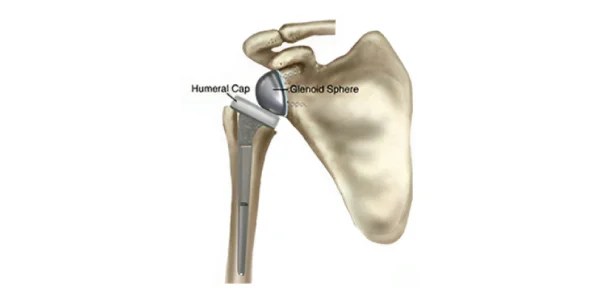 Reverse Shoulder Replacement
