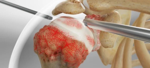 Rheumatoid Arthritis 2