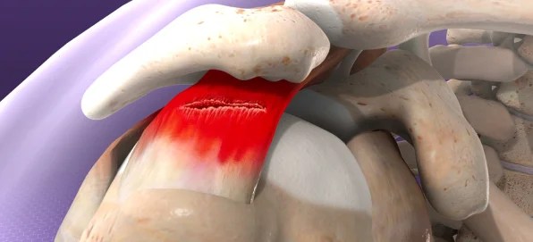 Shoulder Replacement Surgery:a Comprehensive Guide 5 Rotator Cuff Tears