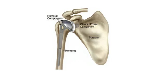 Total Shoulder Replacement