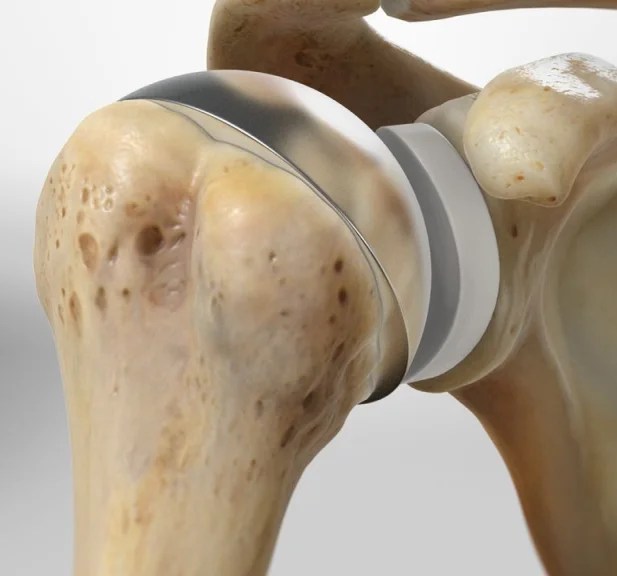 Shoulder Replacement Surgery:a Comprehensive Guide 1 Understanding Shoulder Replacement Surgery