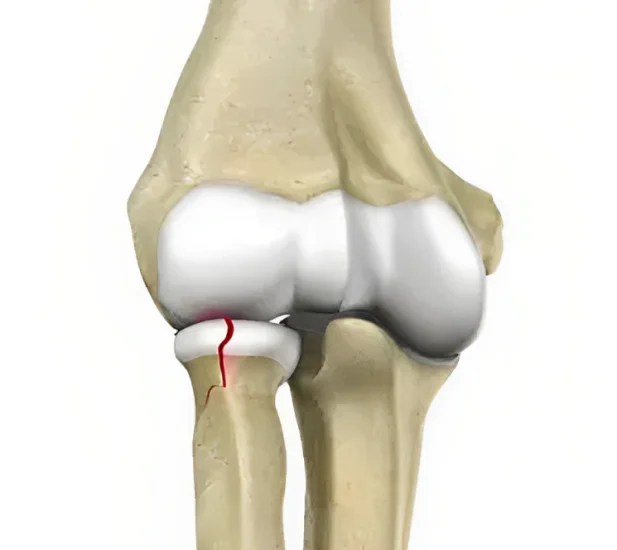 When to Get Elbow Surgery for Fracture