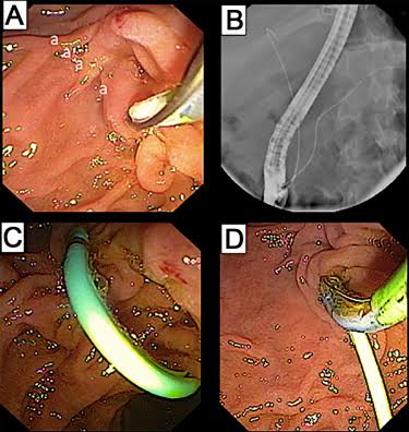 ERCP