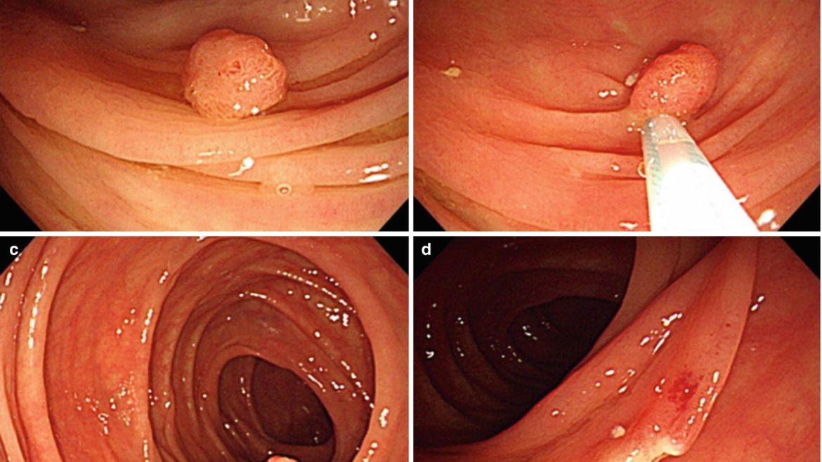 Polypectomy