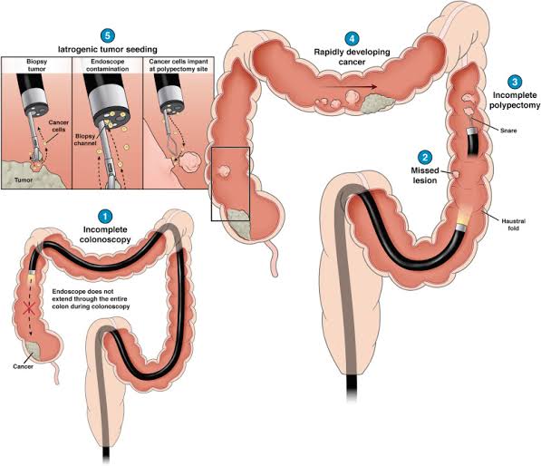 colonoscopy
