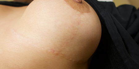 Mastopexia em L: O Que É e Quais as Vantagens?