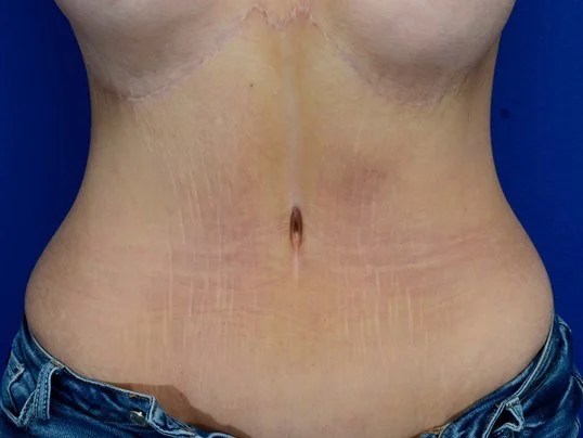 Abdominoplastia Reversa: Antes e Depois