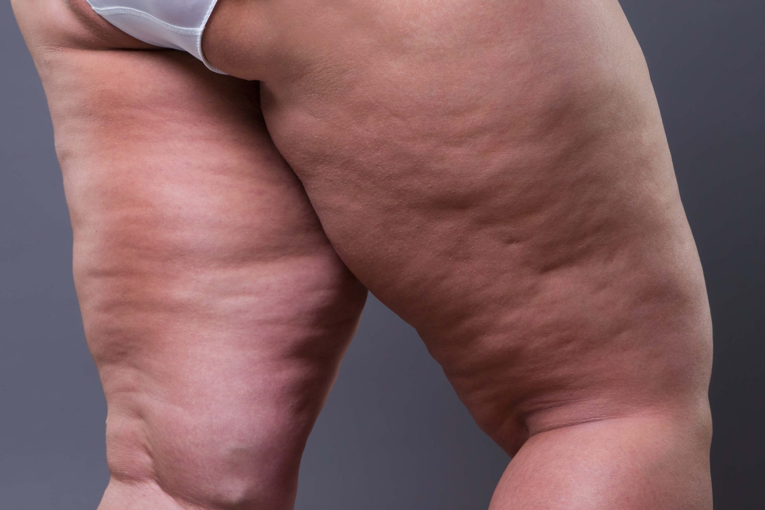 O que é Lipedema?