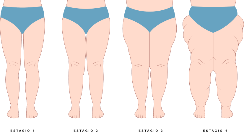 Lipedema
