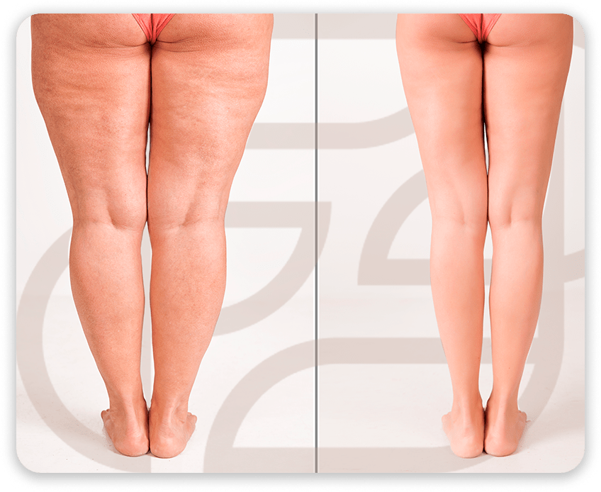 Lipedema