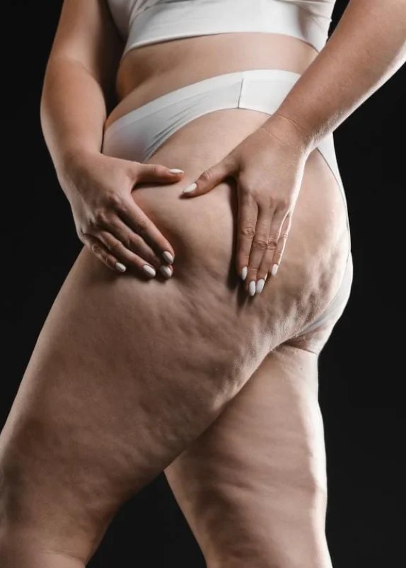 Fibrose após lipoaspiração de lipedema: como identificar, prevenir e tratar
