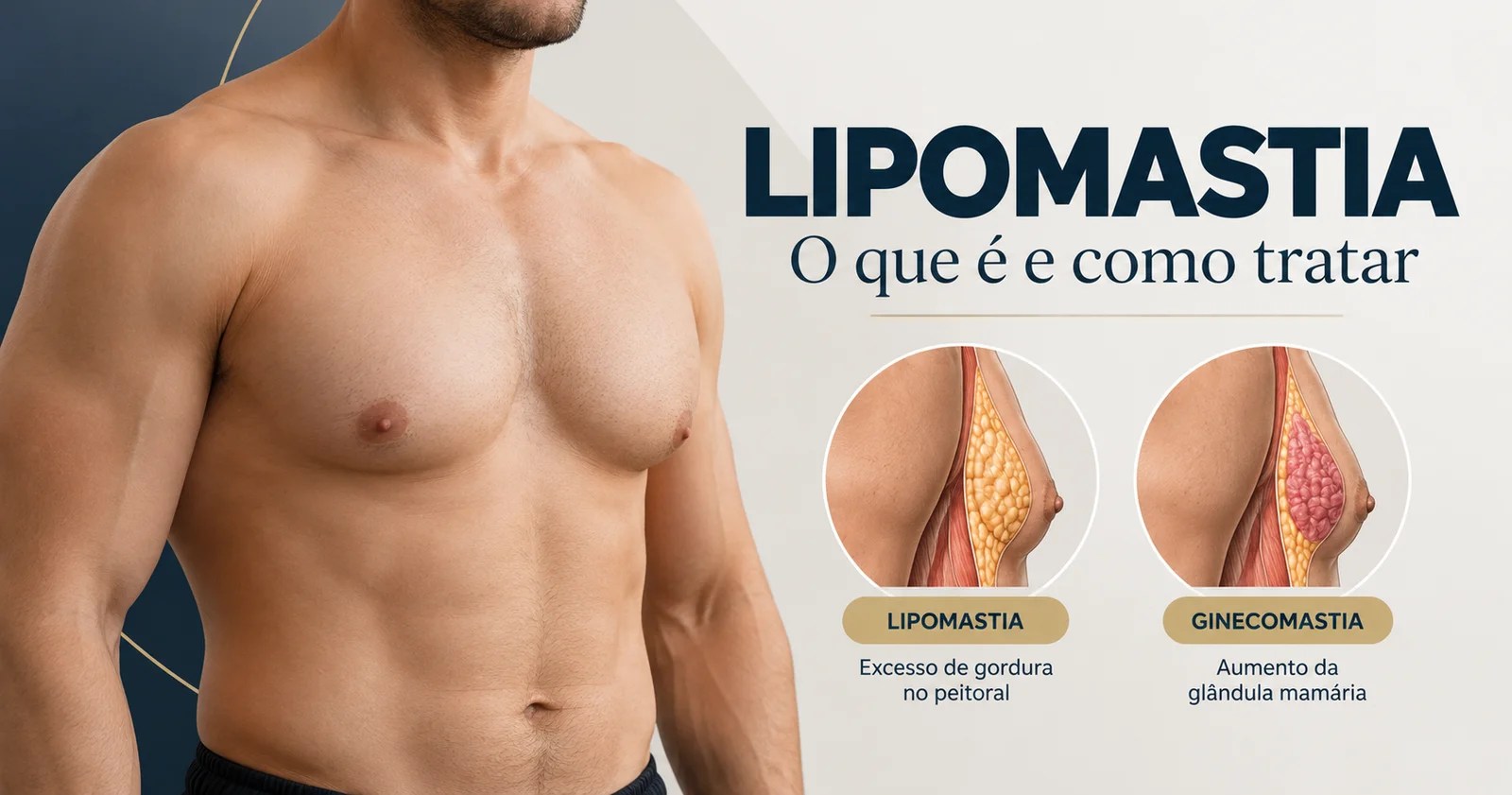 Lipomastia: por que a gordura no peito masculino não sai com treino