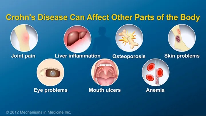 crohn's disease