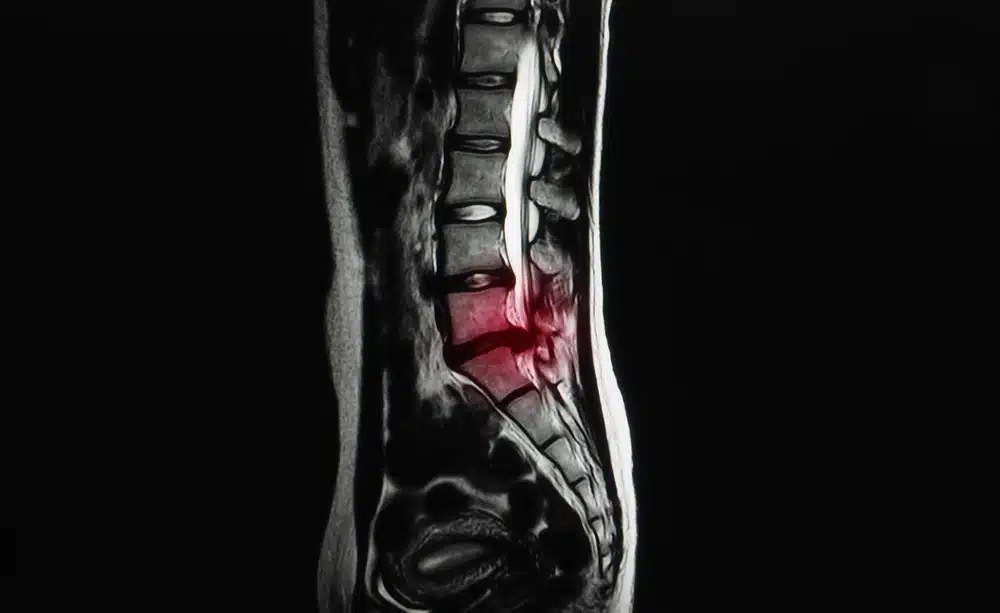 Abaulamento discal: causas e tratamentos
