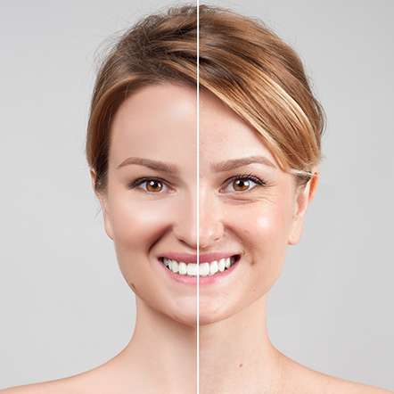 Before and after image showcasing Botox® cosmetic results, softening facial lines and wrinkles.