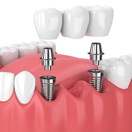 Dental bridge restoration with supporting dental implants and crowns.