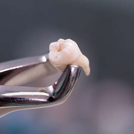 Extracted tooth held in dental forceps, illustrating tooth extraction procedure.
