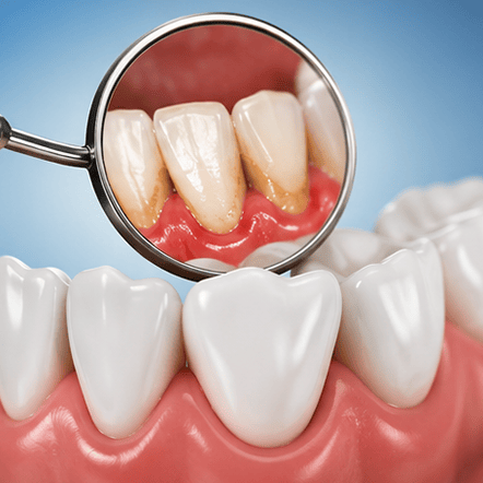 Dental mirror showing inflamed gums and teeth, illustrating periodontal disease symptoms.
