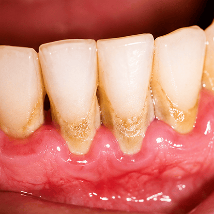 Gum recession and inflammation showing signs of periodontal disease.