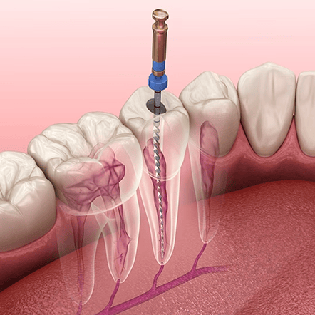 Root canal treatment illustration showing dental instrument inside tooth, preserving natural smiles in St. Petersburg,